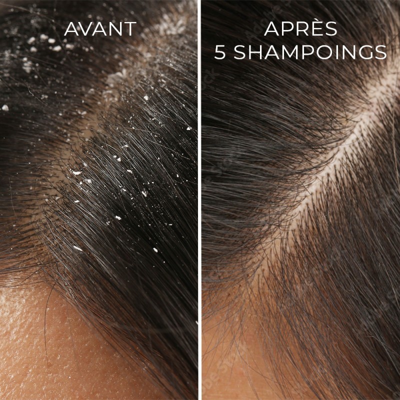 skuteczny szampon przeciwłupieżowy