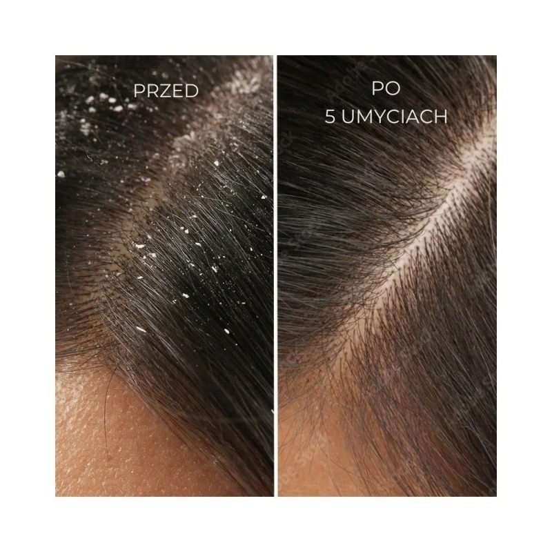 skuteczny szampon przeciwłupieżowy